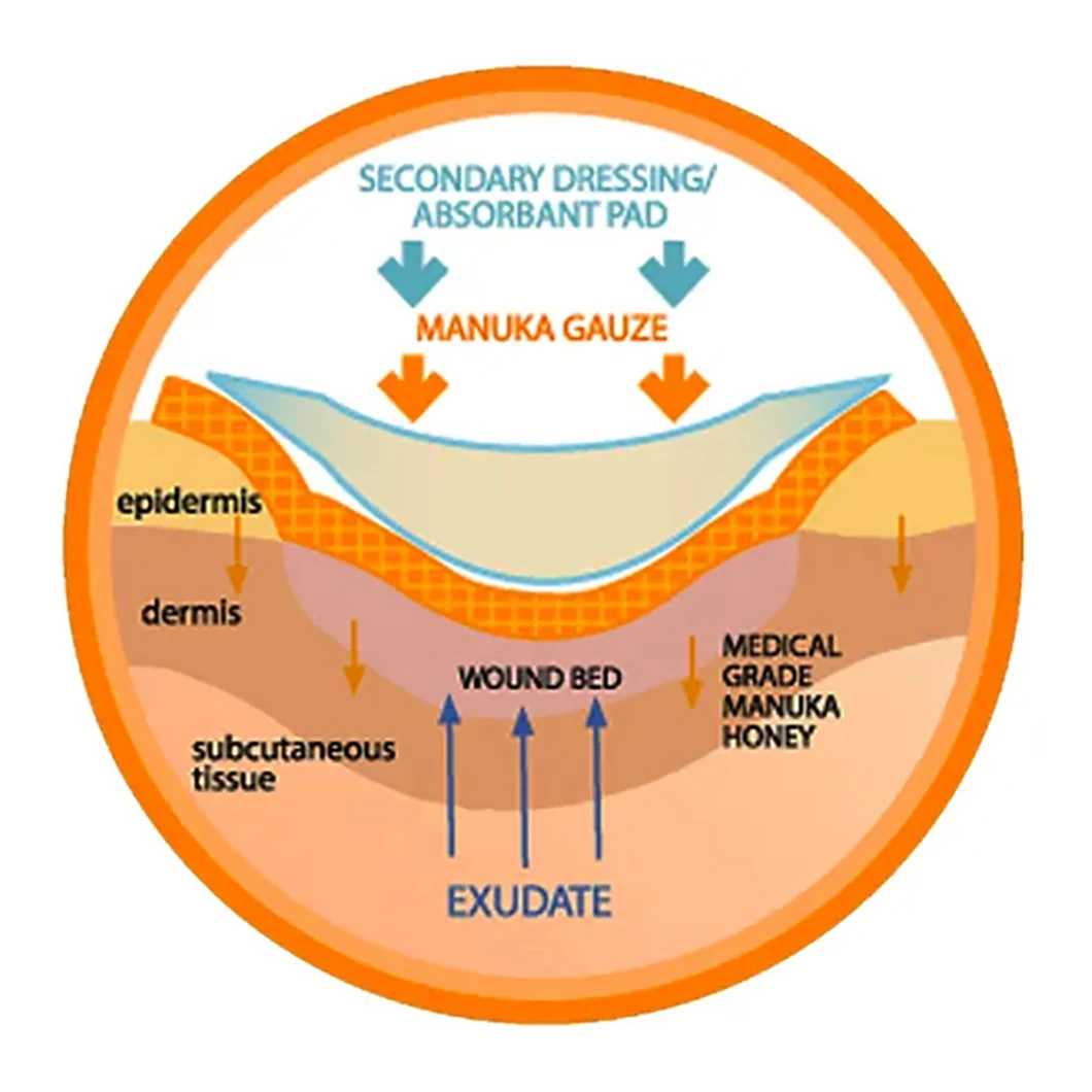 Manuka Honey Medical Wound Dressing Surgical Gauze Dressing